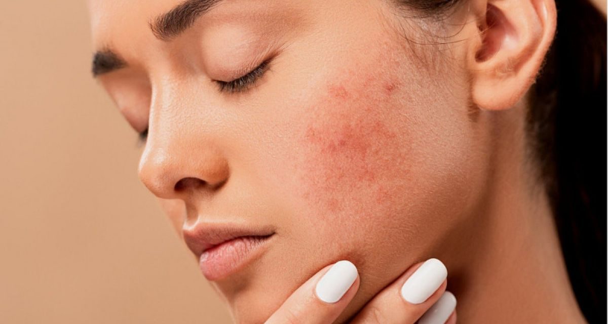 Mengurangi Gula Ampuh Mengatasi Jerawat Daripada Skincare