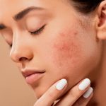 Mengurangi Gula Ampuh Mengatasi Jerawat Daripada Skincare