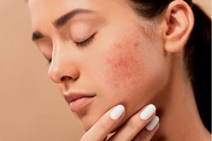 Mengurangi Gula Ampuh Mengatasi Jerawat Daripada Skincare