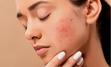 Mengurangi Gula Ampuh Mengatasi Jerawat Daripada Skincare